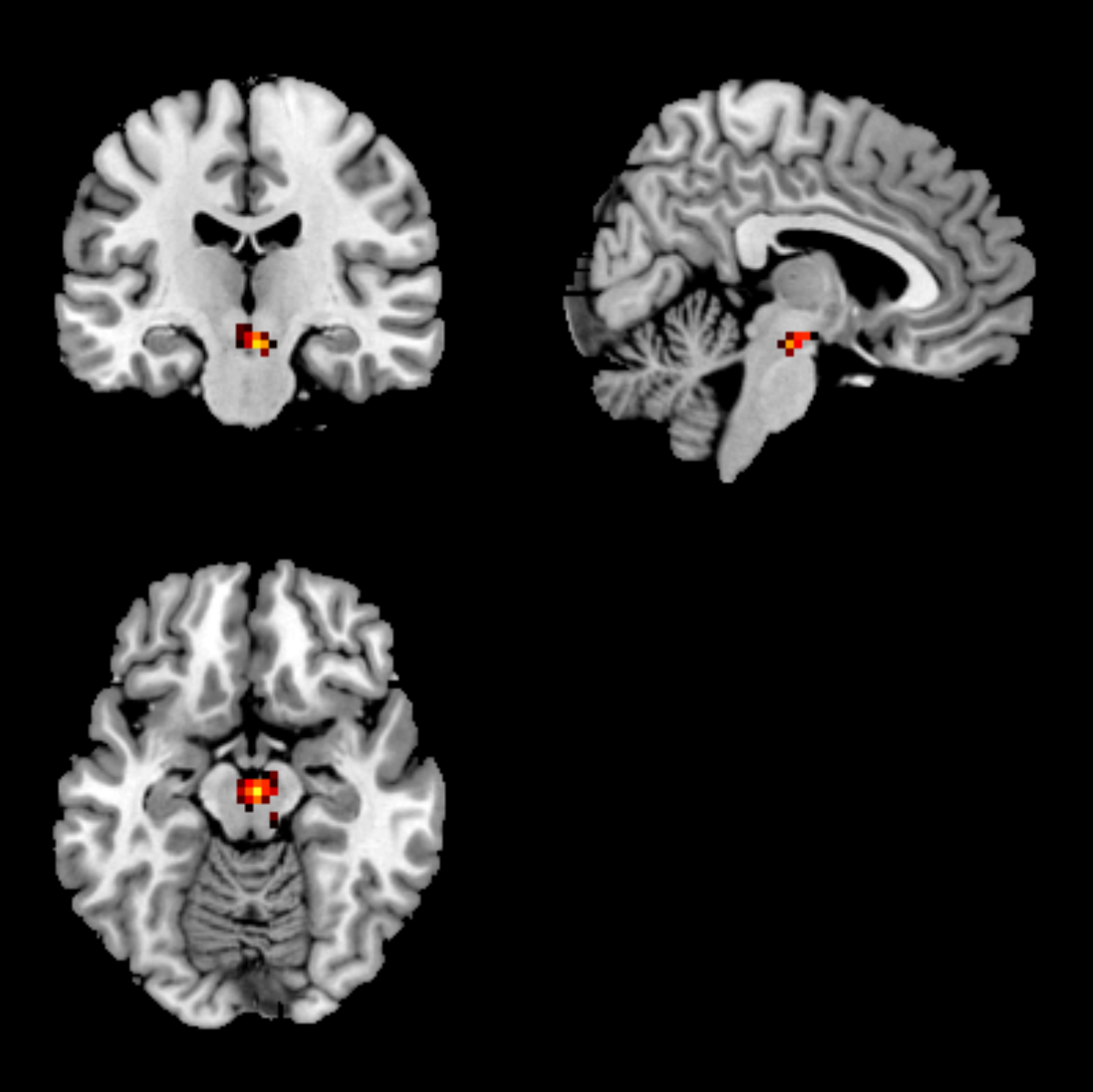 被験者に自分の顔を見せると、上の図にあるドーパミン系の領域が自動的に活性化する。